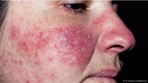 alergia en piel